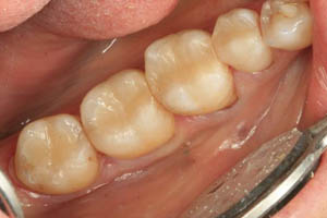 Smile with dark metal fillings replaced by tooth colored composite fillings
