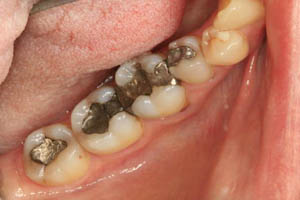 Smile with numerous dark metal fillings on molars