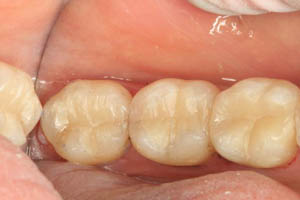 Smile with metal fillings replaced by composite resin dental fillings