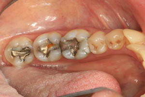 Smile with several metal fillings