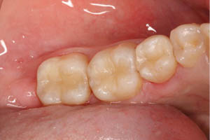 Smile with three dark filling replaced by composite resin dental fillings