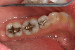 Smile with three dark fillings on molars