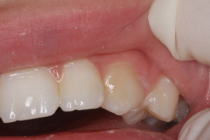 Smile with tooth damage and discoloration repaired by composite resin dental fillings