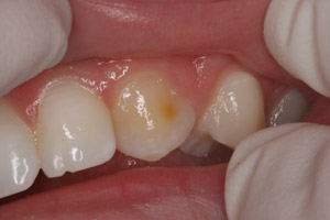 Smile damaged and discolored tooth