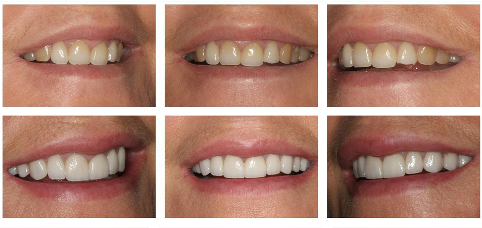 Closeup of smile from three angles before and after porcelain veneer cosmetic dentistry