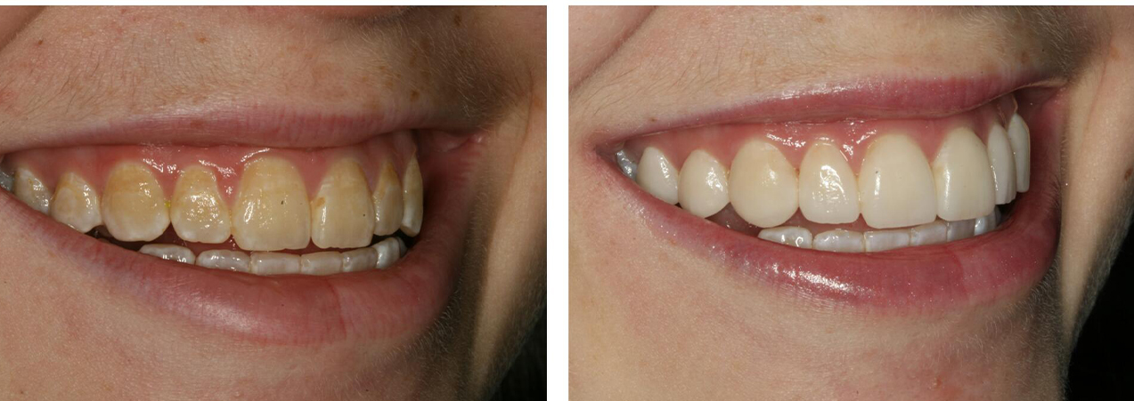 Smile before and after no prep dental veneers