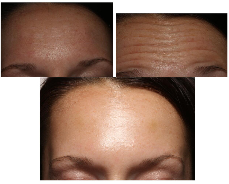 Closeup of patient before and after Botox and Juvederm treatment
