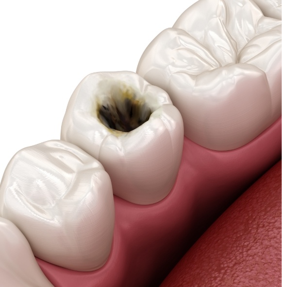 Animated smile with severe tooth decay in need of dental crown restoration