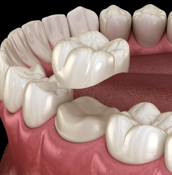 Animated smile showing the dental crown placement process