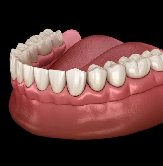 Animated smile during full denture placement
