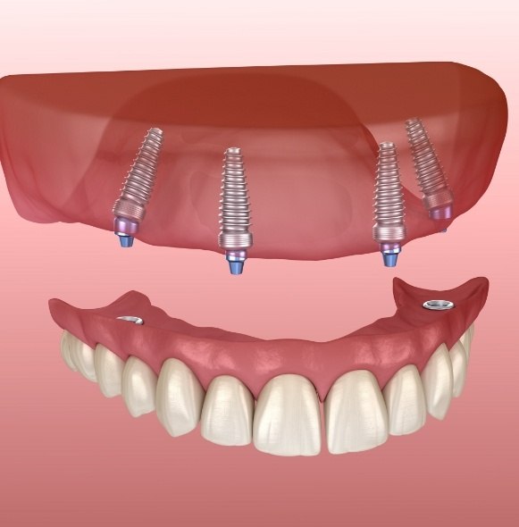 Dentures in Kittanning