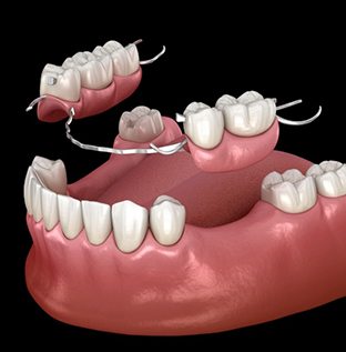 Partial dentures in Kittanning