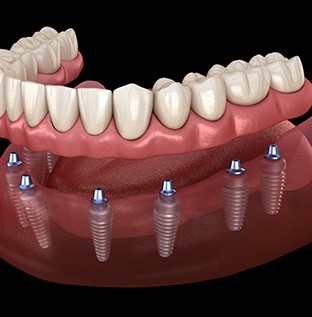 Implant dentures in Kittanning