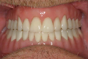 Flawless smile after dental implant supported denture restoration