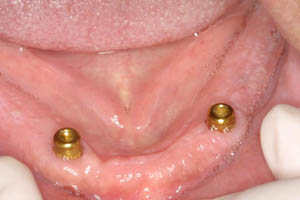 Smile without teeth showing newly placed dental implant posts