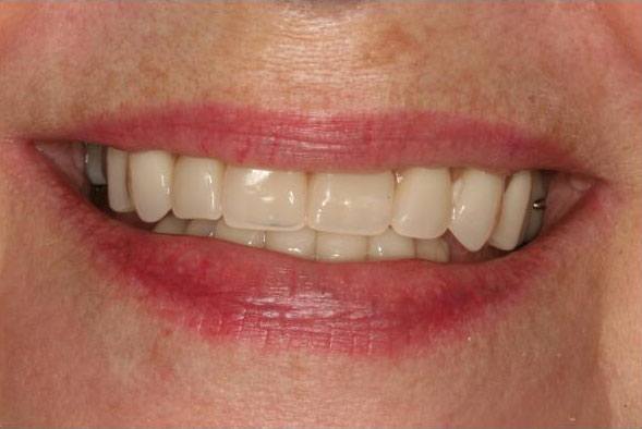 Missing top teeth replaced with dental implant supported denture