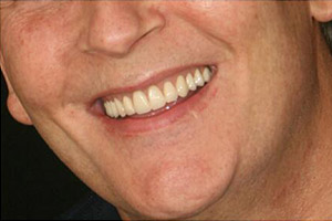 Smile flawlessly restored with a dental implant supported denture