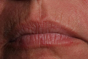 Mouth with deep lines and wrinkles