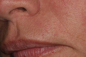 Mouth with smooth upper lip after dermal filler