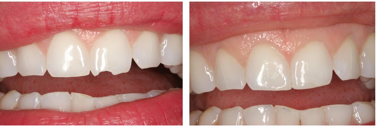 Closeup of smile before and after emergency dentistry to repair broken tooth