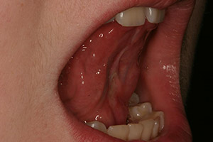 Closeup of young patient's smile after frenectomy treatment for tongue tie