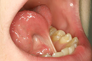 Closeup of patient with tongue tie before frenectomy treatment
