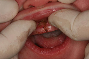 Closeup of patient's smile after frenectomy treatment for lip tie