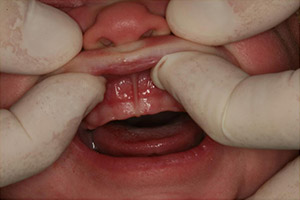 Closeup of smile with lip tie before frenectomy treatment