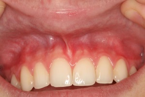 Closeup of smile after lip tie treatment
