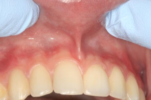 Closeup of smile before lip tie treatment