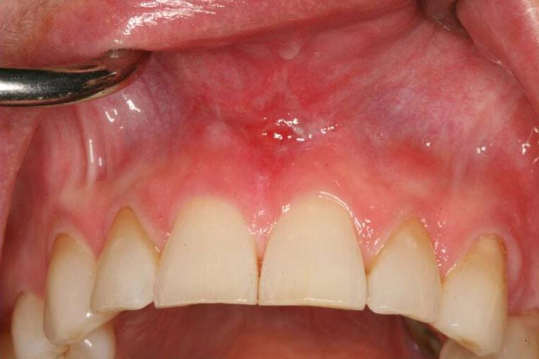 Smile after excess tissue is removed during frenectomy