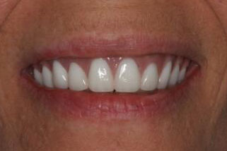 Closeup of damaged smile replaced with dentures