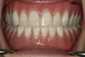 Closeup of smile with missing teeth replaced by partial dentures