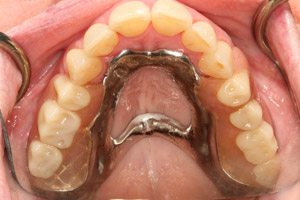 Smile with dental implant supported partial denture