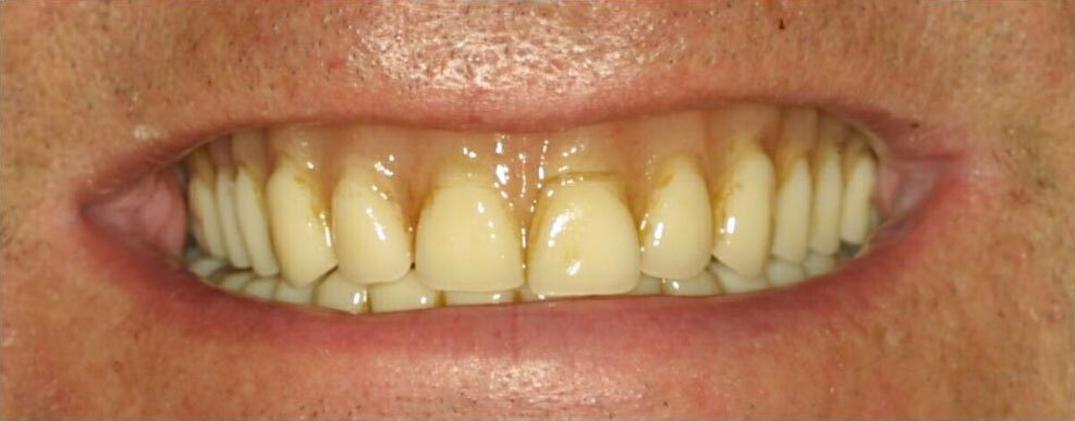 Older looking damaged denture