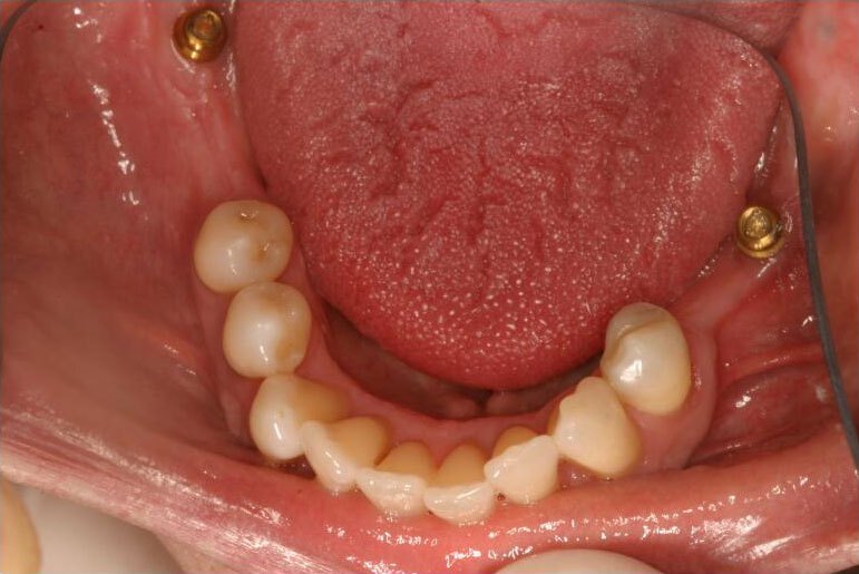 Smle with numerous missing teeth