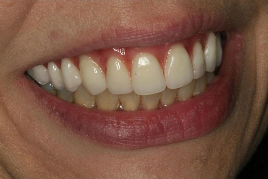 Smile with missing teeth on one side replaced by partial denture