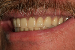 Smile with natural looking upper arch denture