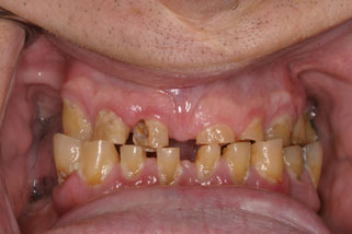 Closeup of smile with extenstive tooth decay and damage
