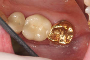 Tooth with filling replaced by gold dental crown