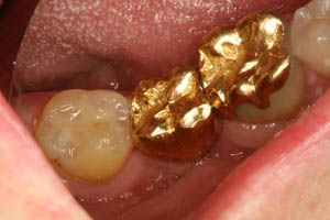 Smile with older dental restorations replaced with gold dental crowns