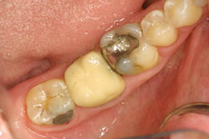 Smile with older dental restorations that need to be replaced