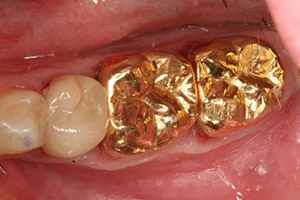 Two dental crowns repairing damaged teeth