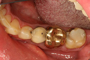 Two damaged teeth in a row