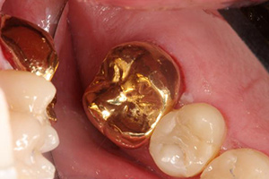 Damaged back bottom tooth repaired with gold dental crown
