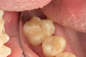 Damaged back bottom tooth