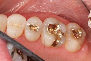 Teeth repaired with gold dental restorations