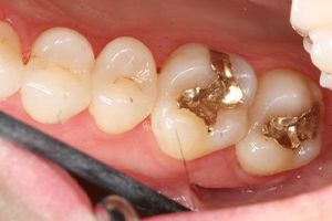 Damaged teeth with old dental fillings