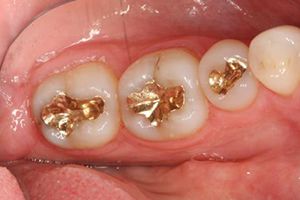 Smile with three gold dental fillings after repairing additional dental damage