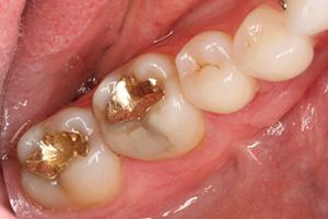 Smile with two gold dental fillings and one damged tooth